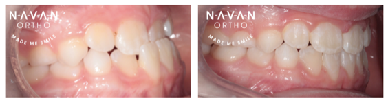 Crossbite | Braces | Navan Orthodontics | 6 month braces | Kids Braces