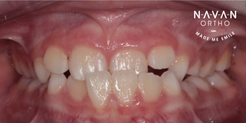 Crossbite | Braces | Navan Orthodontics | Orthodontist | Interceptive treatment | Kids braces
